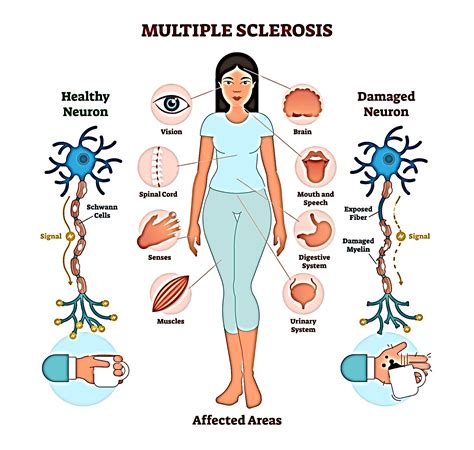 A 50-year-old female client recently diagnosed with multiple sclerosis, presents to the clinic after having a history of several neurological symptoms and is asking the nurse about her condition. . The nurse is teaching a female client with multiple sclerosis
